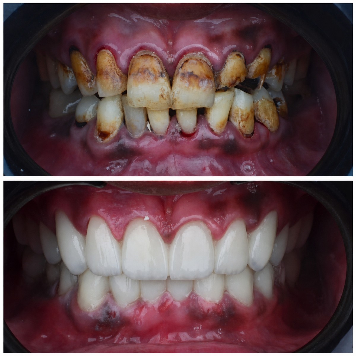 نتائج قبل وبعد تركيب تيجان الزركونيا في Omara Dental Centers، استعادة الابتسامة