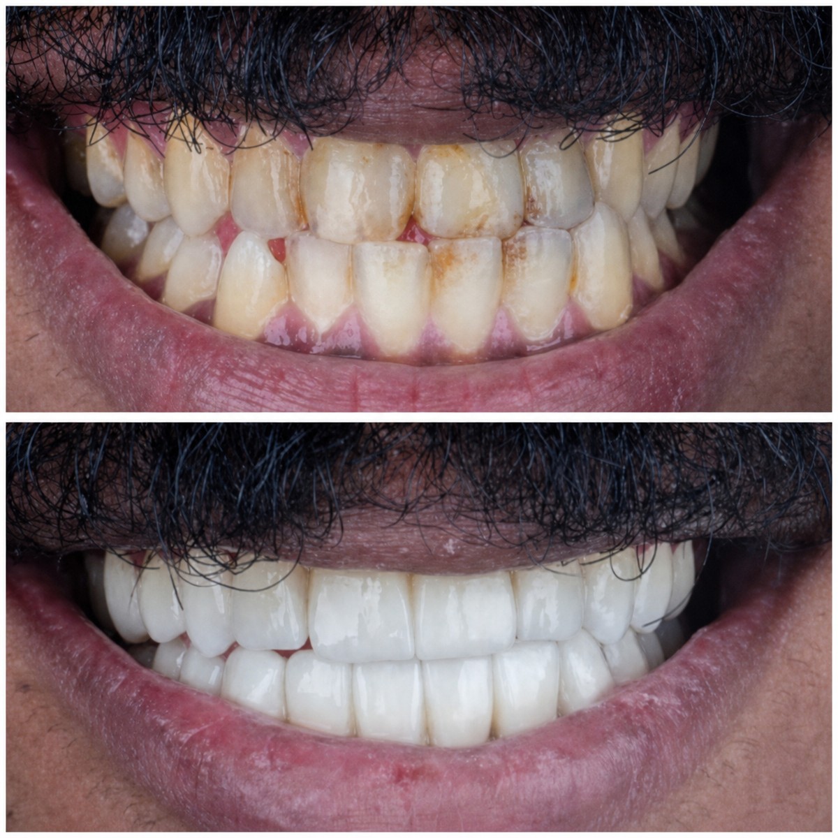 Голливудская улыбка до и после в Omara Dental Centers – белые, ровные зубы