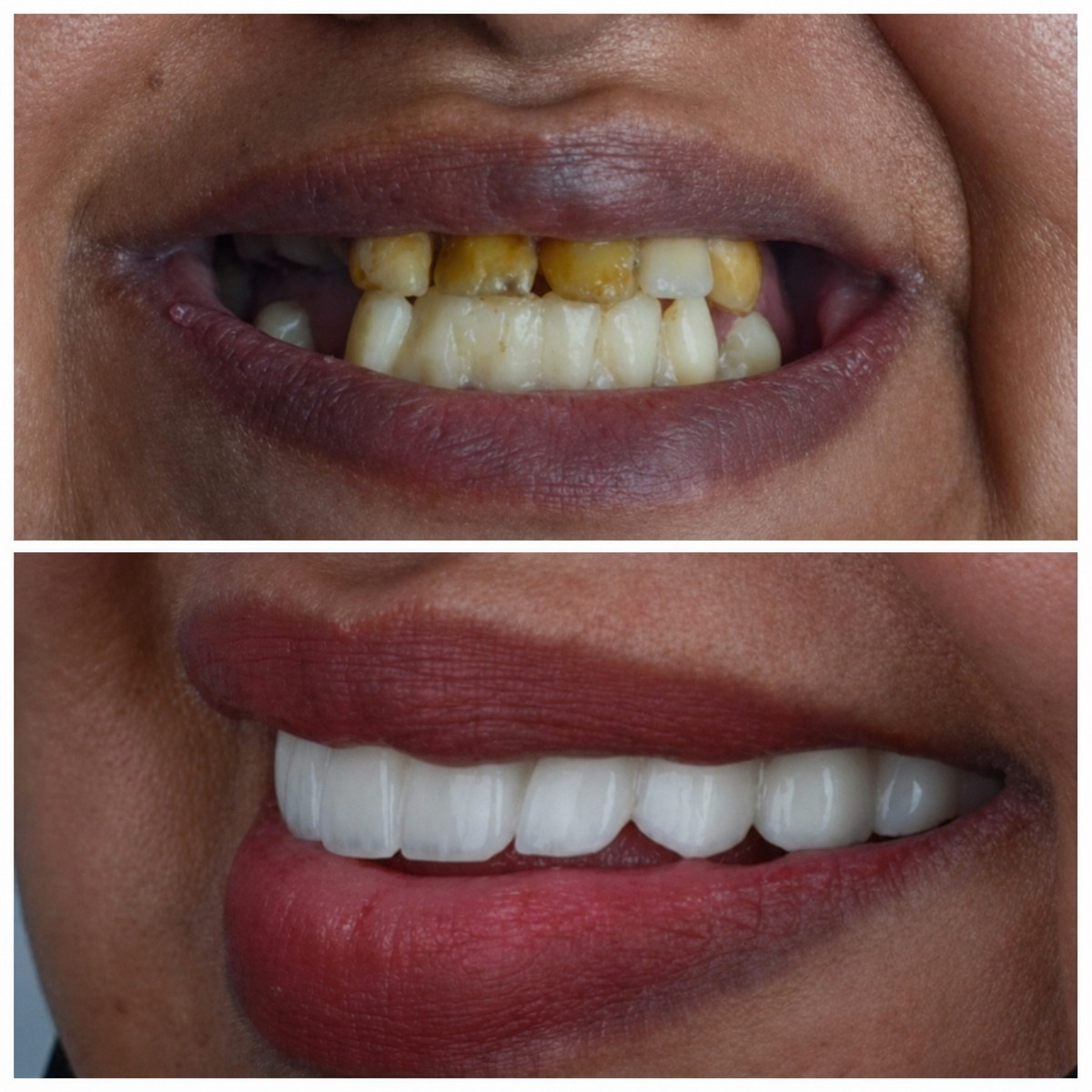 Before and after All-on-6 dental implants result at Omara Dental Centers, improved smile