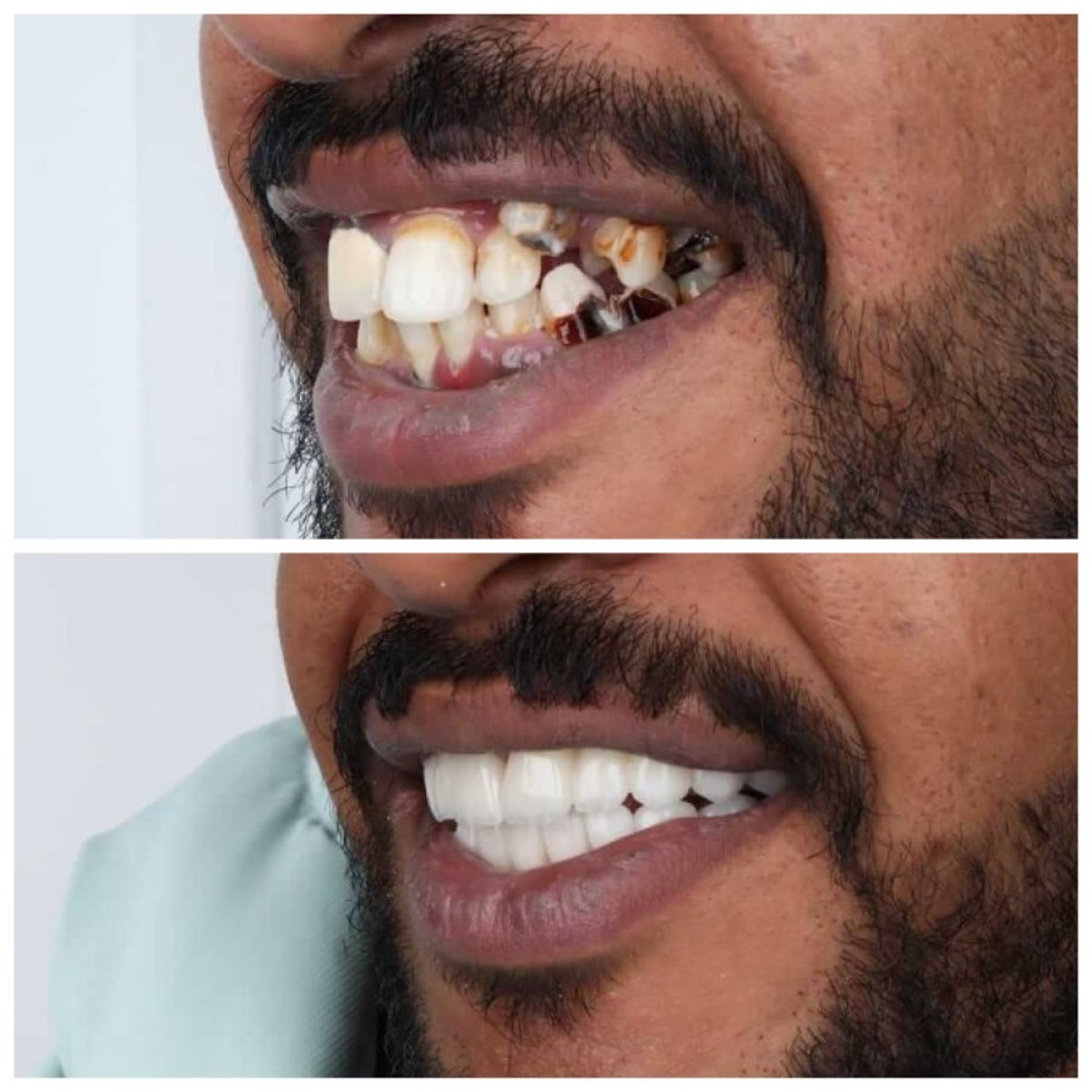До и после установки виниров в Omara Dental Centers – преображение улыбки, естественный результат
