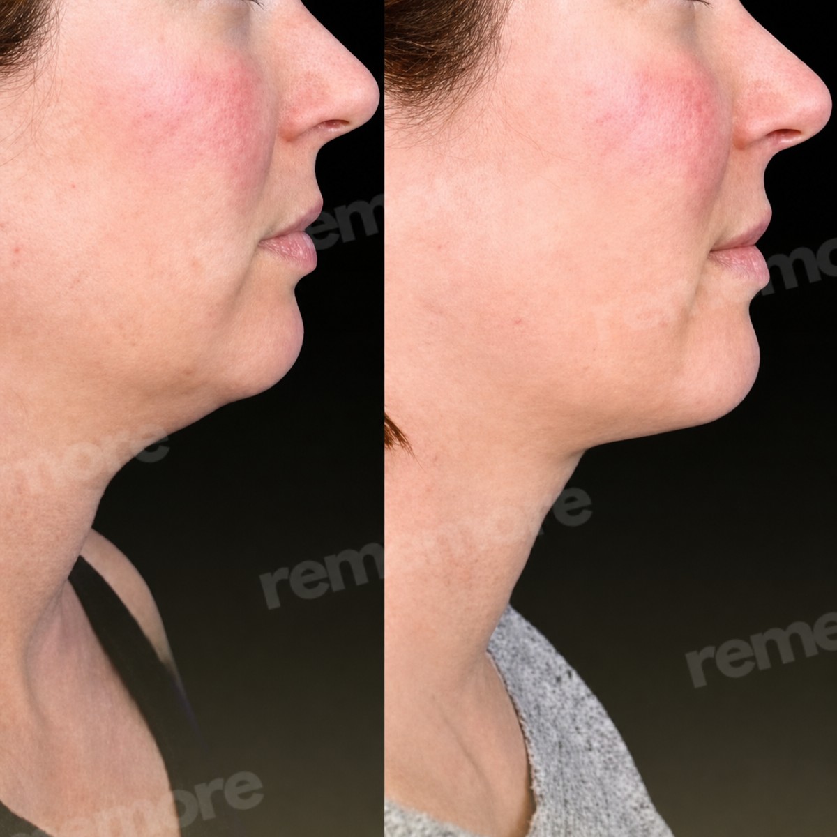 Before and after chin liposuction results at Memorial Şişli Hospital, improved jawline contour