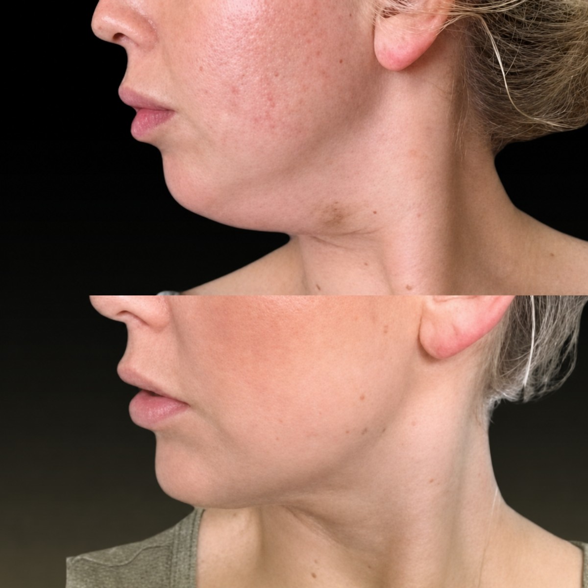Before and after chin liposuction results at Memorial Şişli Hospital, improved jawline contour