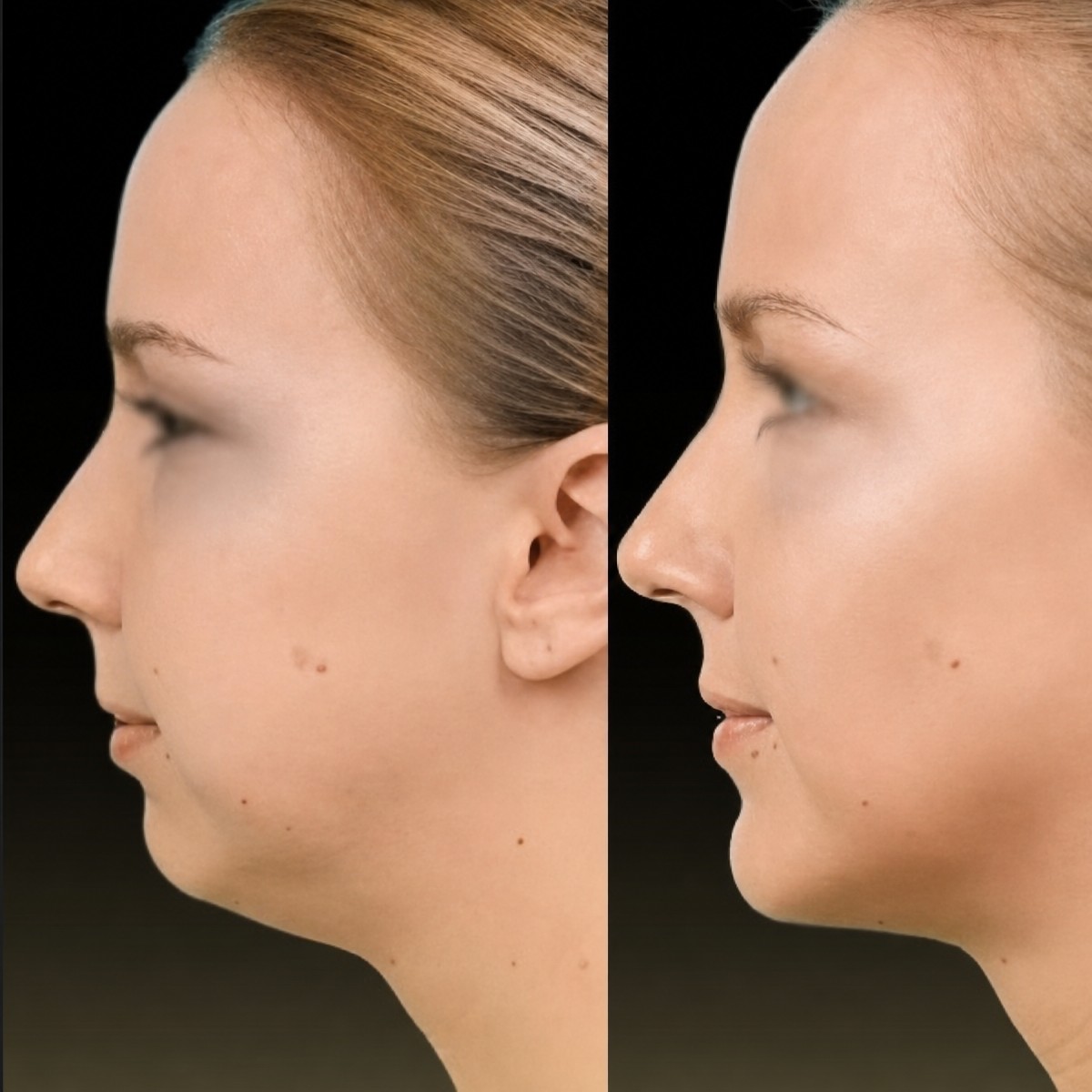Before and after chin liposuction results at Memorial Şişli Hospital, improved jawline contour
