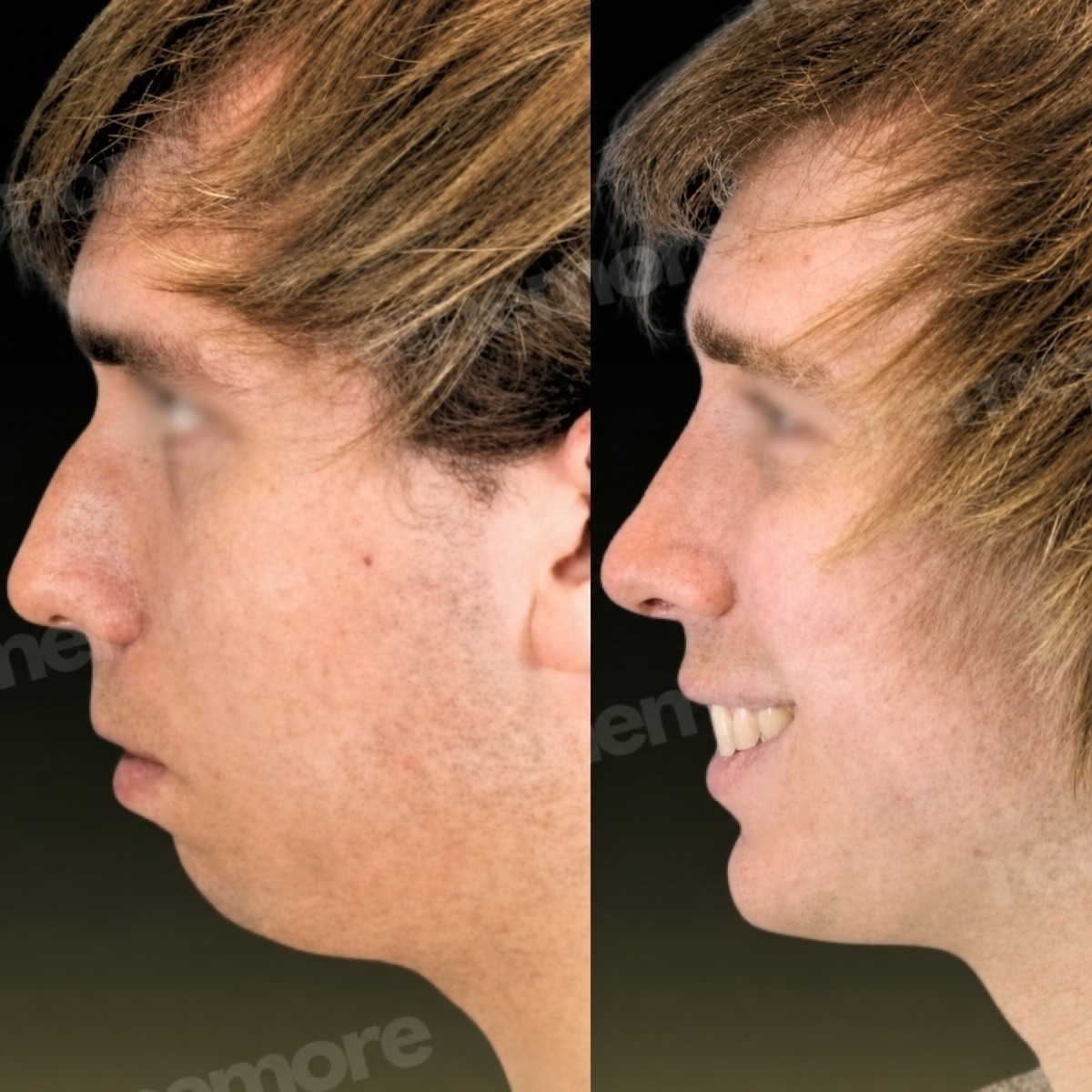 Before and after chin liposuction results at Memorial Şişli Hospital, improved jawline contour