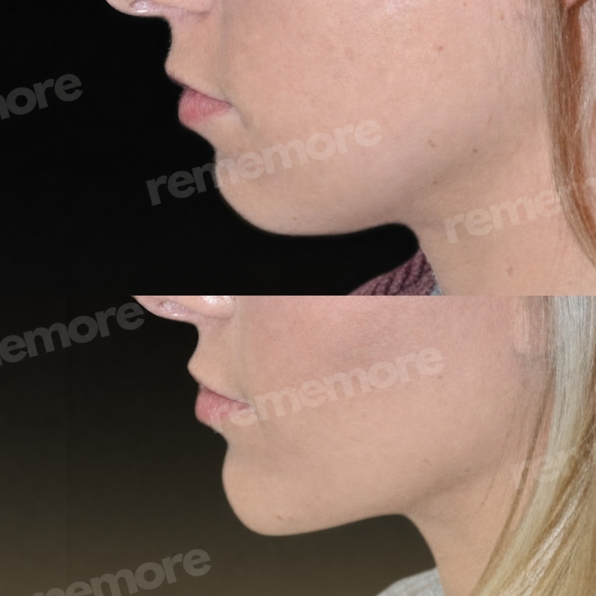 Before and after chin liposuction results at Memorial Şişli Hospital, improved jawline contour