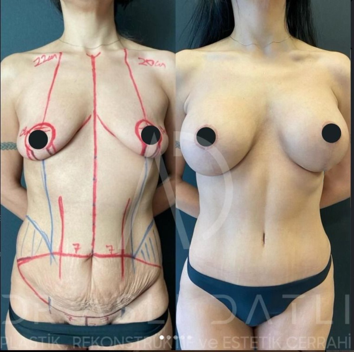 Before and after breast implants with breast lift at Liv Hospital Ulus, enhanced breast shape result