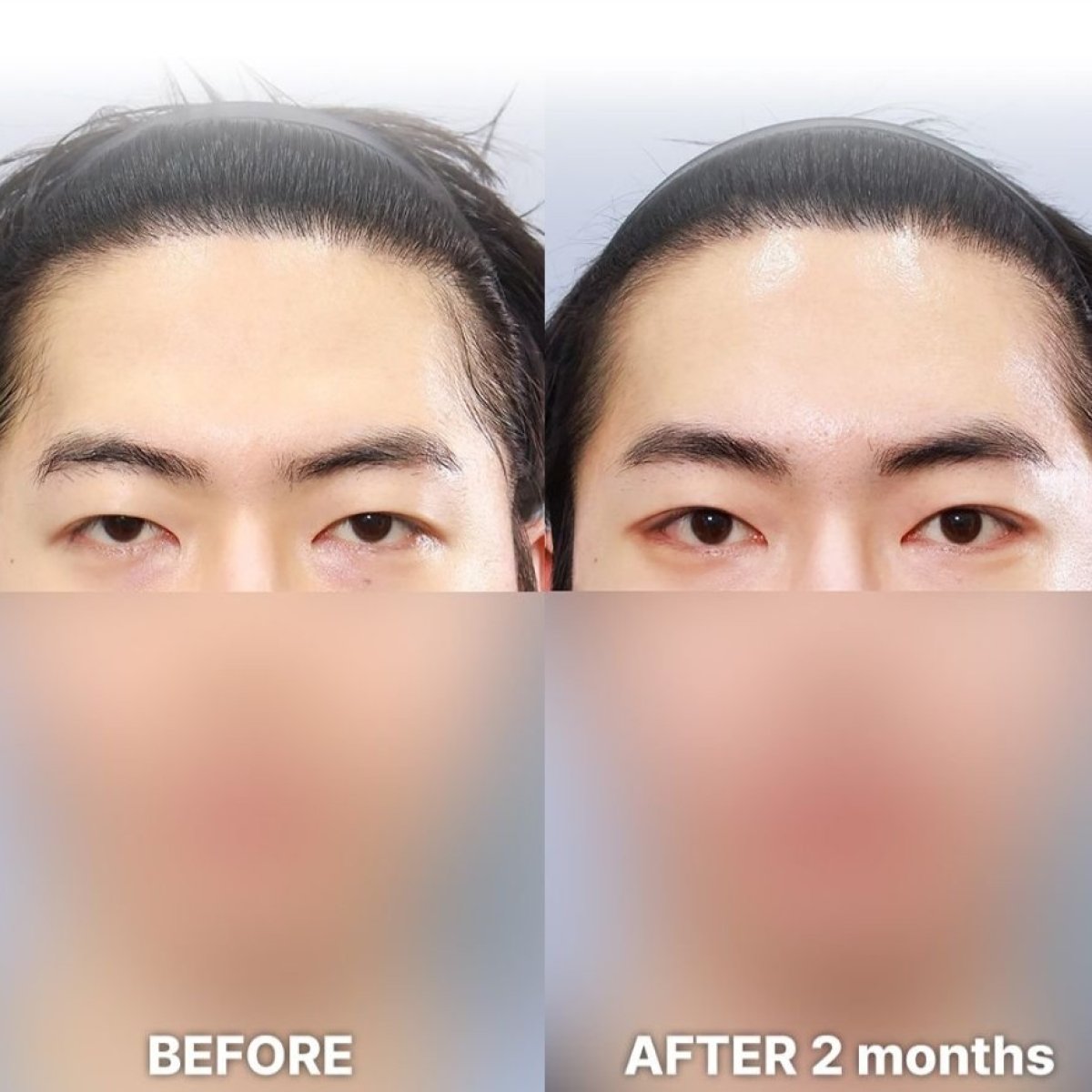 Droopy eyelid surgery before and after results at Returning Plastic Surgery, 2 months post-op