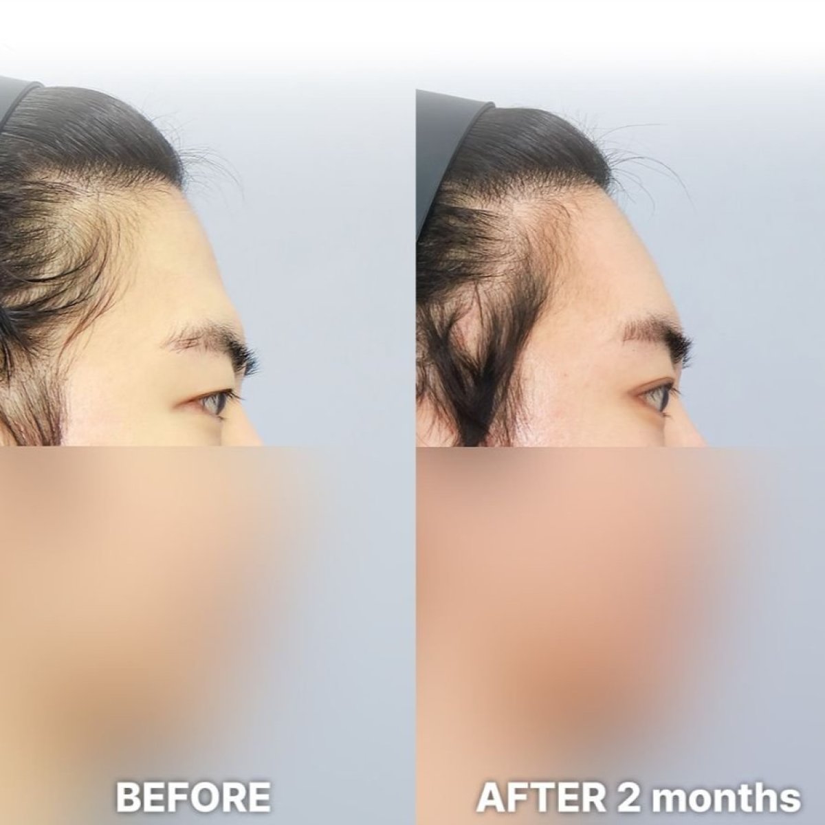 Before and after droopy eyelid surgery results at Returning Plastic Surgery, 2 months post-op