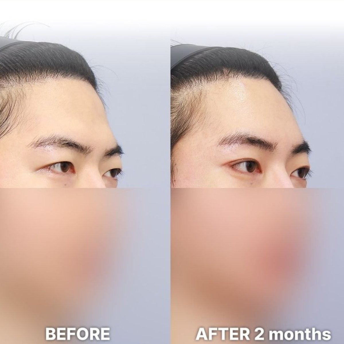Before and after droopy eyelid surgery results at Returning Plastic Surgery, 2 months post-op