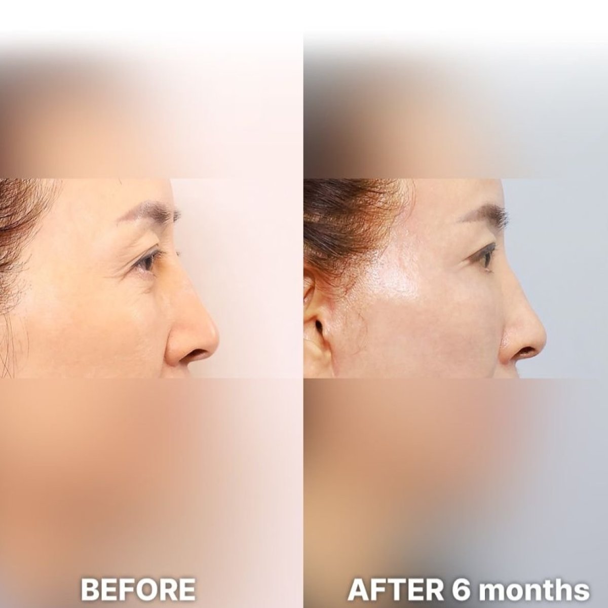 Результати пластики опущених повік до і після в Returning Plastic Surgery, 6 місяців