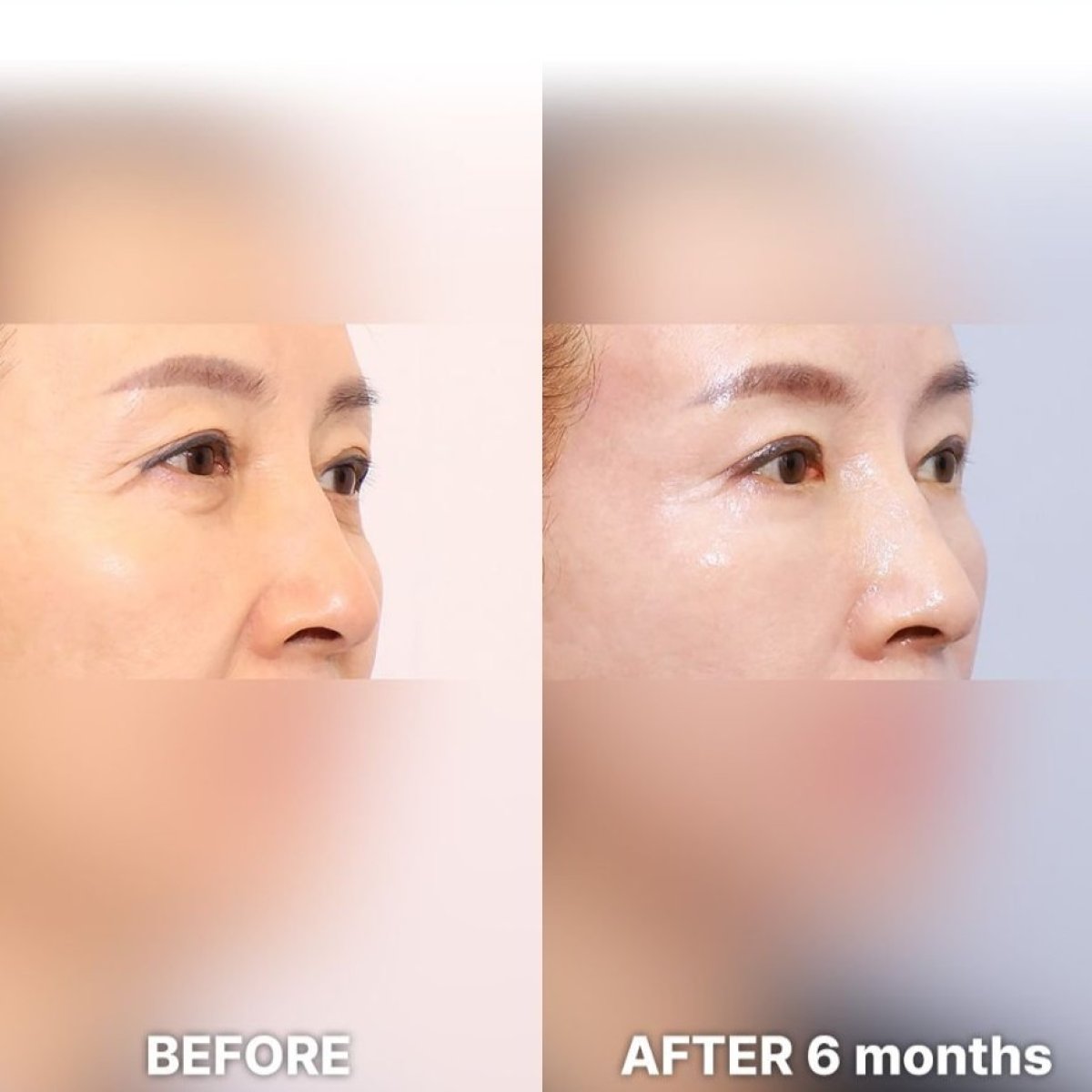 Результаты блефаропластики век до и после в Returning Plastic Surgery, 6 месяцев после