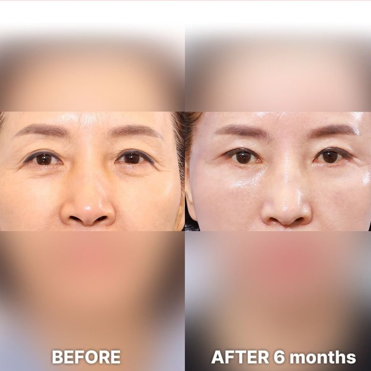 Droopy eyelid surgery before and after 6 months result at Returning Plastic Surgery clinic