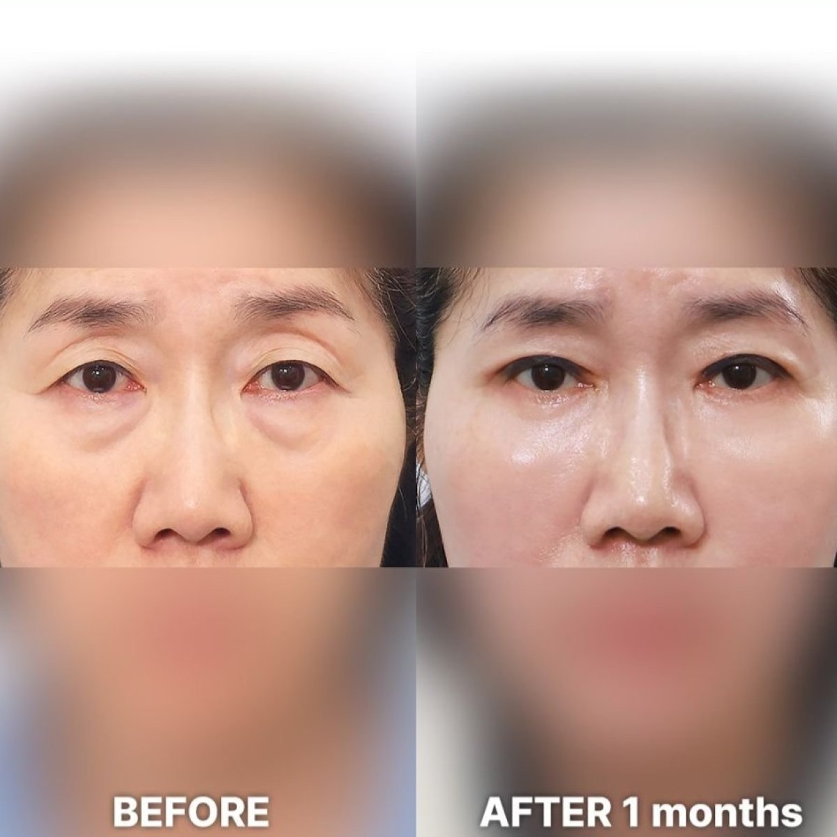Efekty przed i po operacji opadających powiek w Returning Plastic Surgery, poprawiony kontur oka
