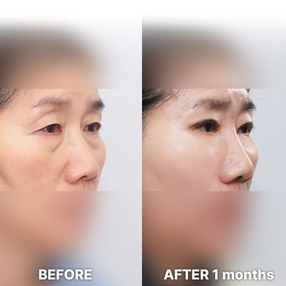 Before and after droopy eyelid surgery results at Returning Plastic Surgery, improved eye contour