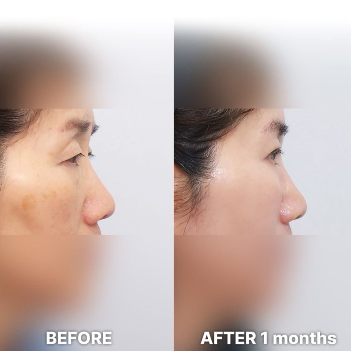 Droopy eyelid surgery before and after results at Returning Plastic Surgery, improved eyelid contour