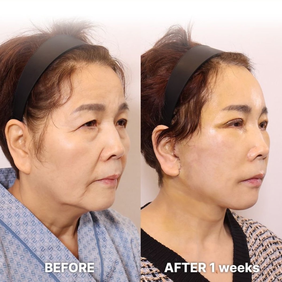 Résultats avant/après mini lifting chez Returning Plastic Surgery, rajeunissement visible