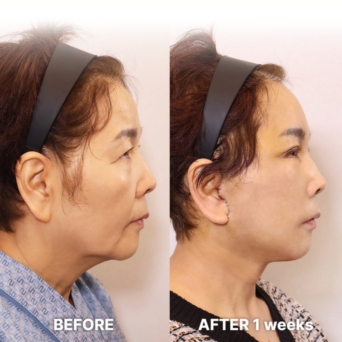 Before and after mini facelift result at Returning Plastic Surgery, visible facial contour lift