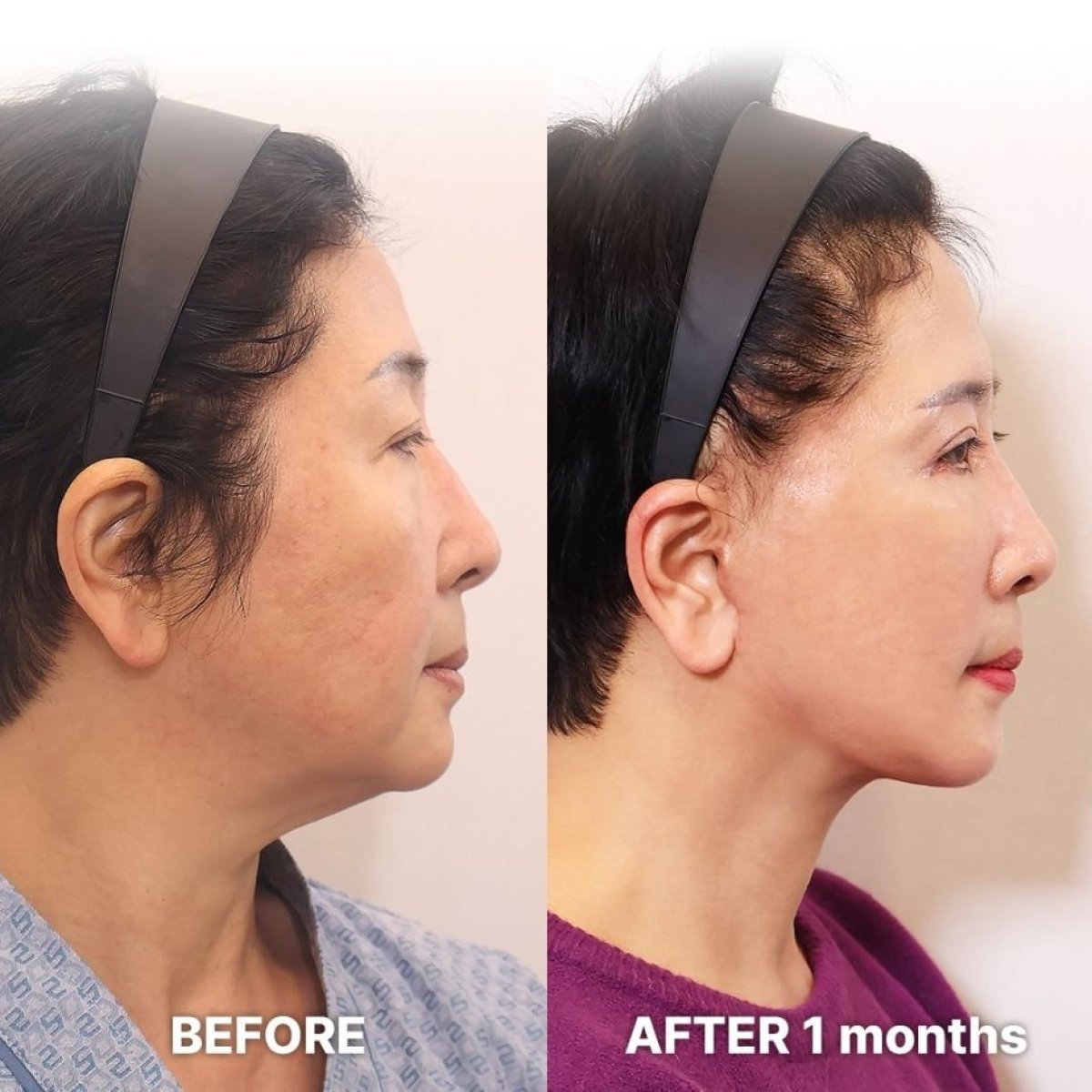 Résultats avant/après mini lifting du visage chez Returning Plastic Surgery, rajeunissement