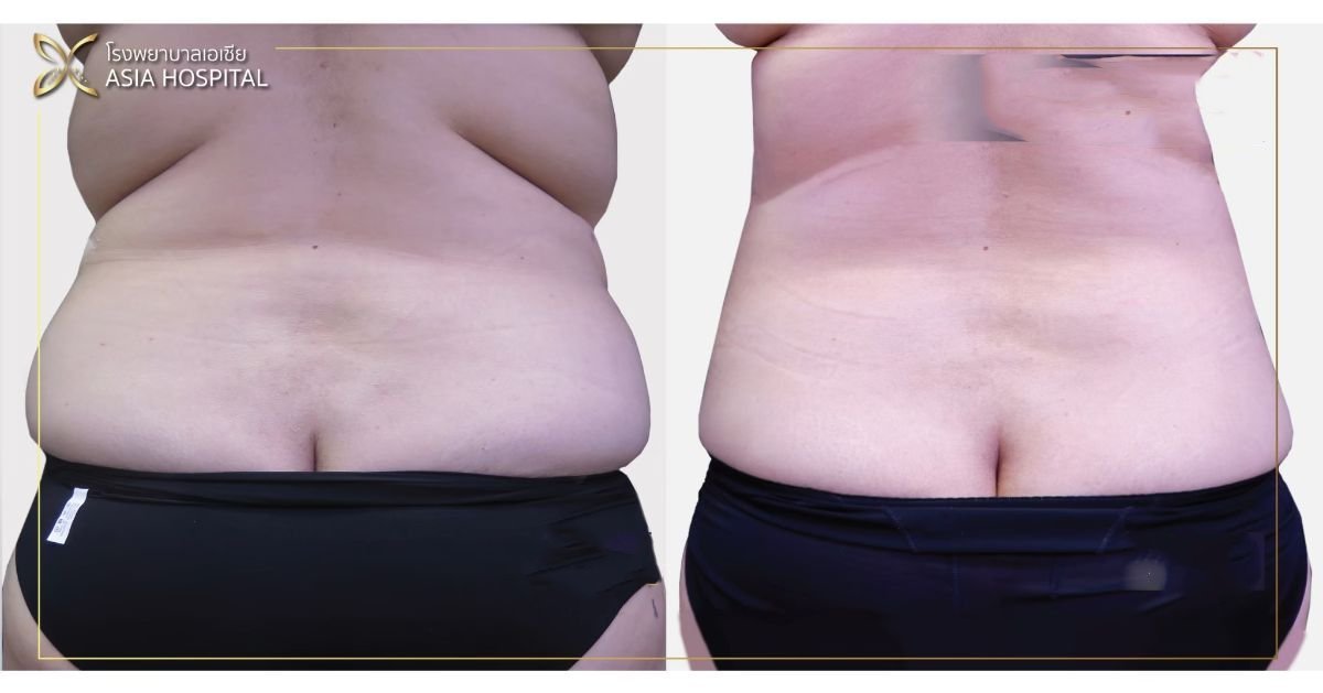 Résultats avant et après liposuccion Vaser à Asia Cosmetic Hospital, taille affinée visible
