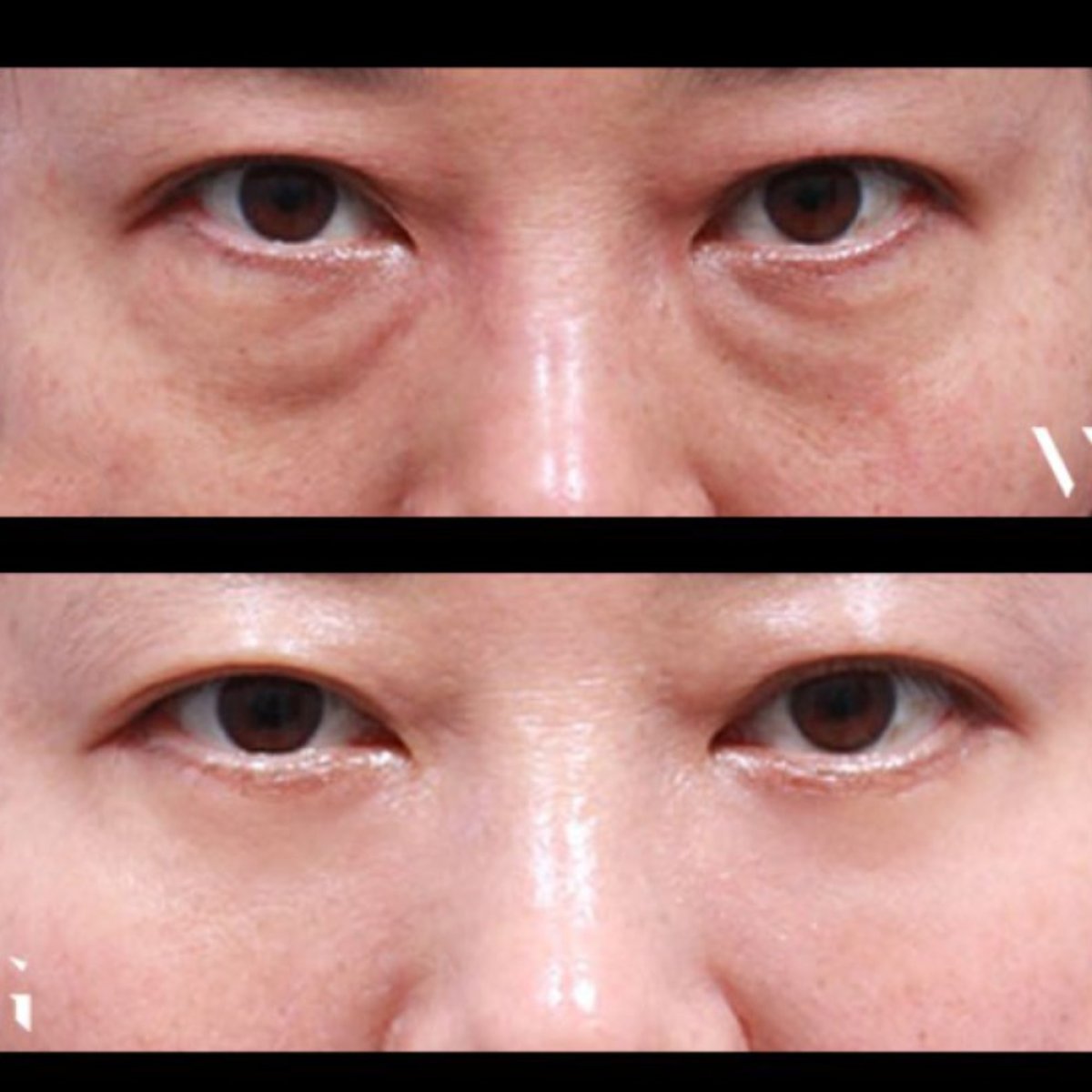 Antes y después de blefaroplastia en VG Plastic Surgery, corrección de párpados con resultado suave