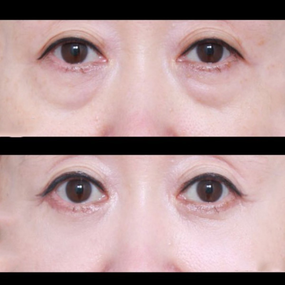 Resultados de blefaroplastia antes y después en VG Plastic Surgery, corrección de párpados