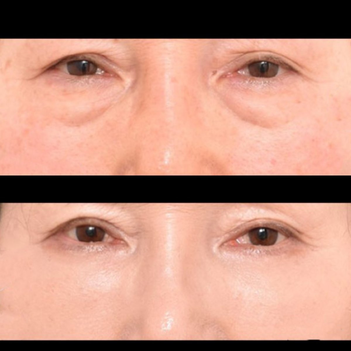 Resultados de blefaroplastia antes y después en VG Plastic Surgery, mejora de párpados