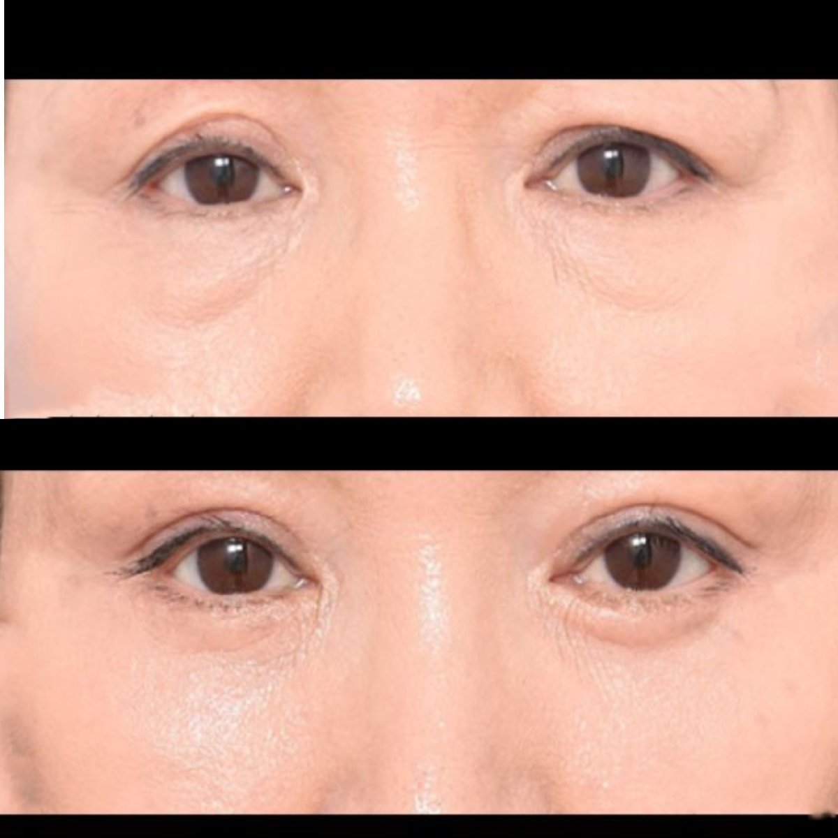 Before and after blepharoplasty results at VG Plastic Surgery, eyelid correction improvement