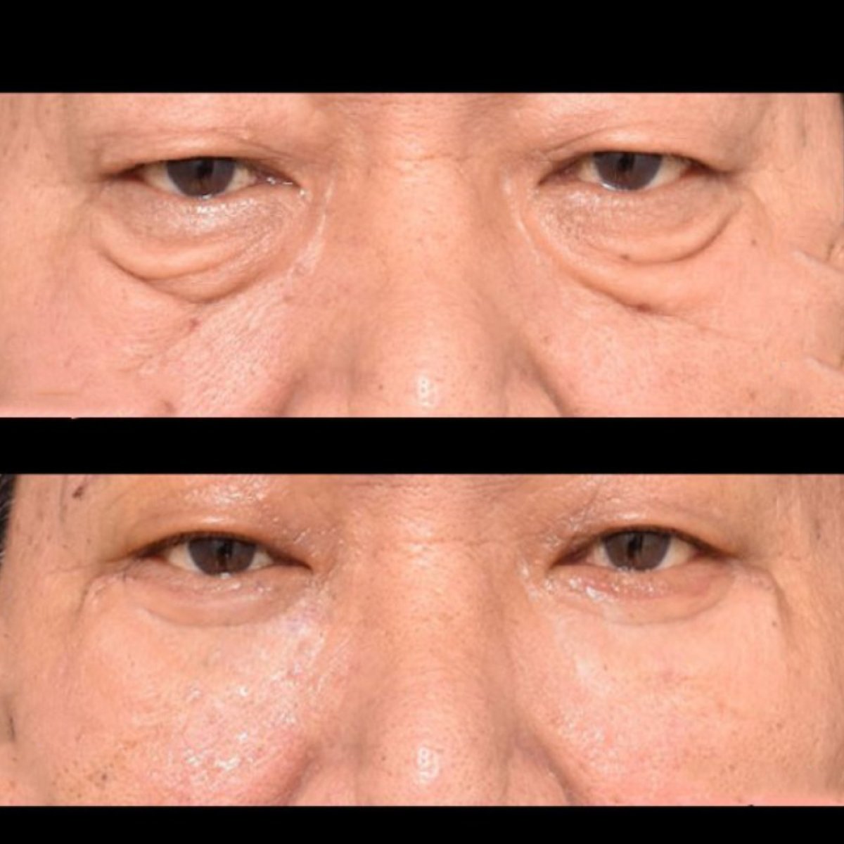 Before and after blepharoplasty results at VG Plastic Surgery, reduced under-eye bags