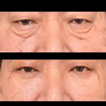 Dr. Im Young Min тарапынан Блефаропластика (қабақ қалыпқа келтіру) бұрын және кейін фотосуреттері