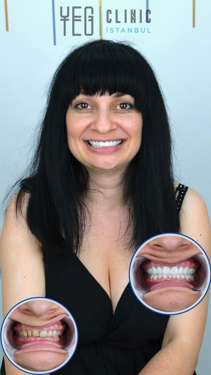 نتائج قبل وبعد تركيب تيجان الأسنان في YEG Clinic، ابتسامة محسنة