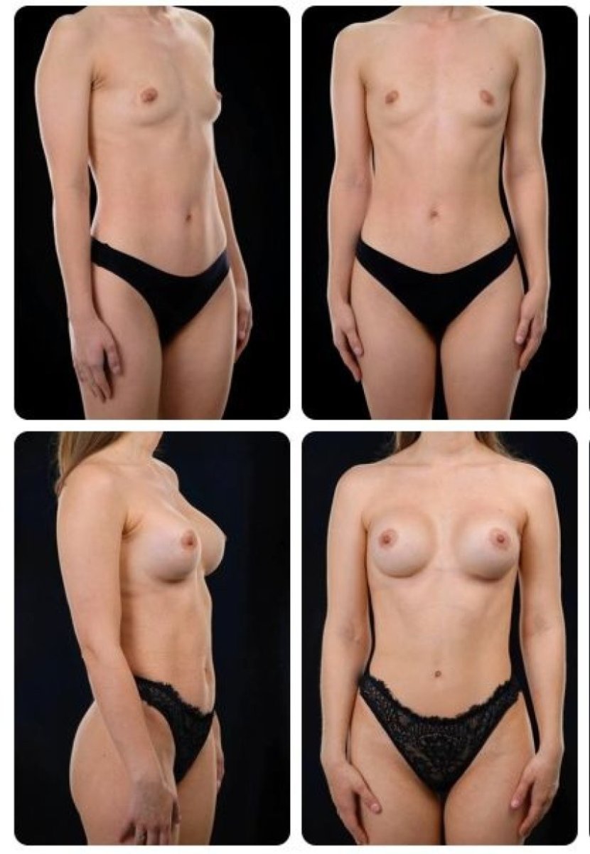 Before and after breast augmentation results at Yurchenko Plastic Surgery Team Kyiv