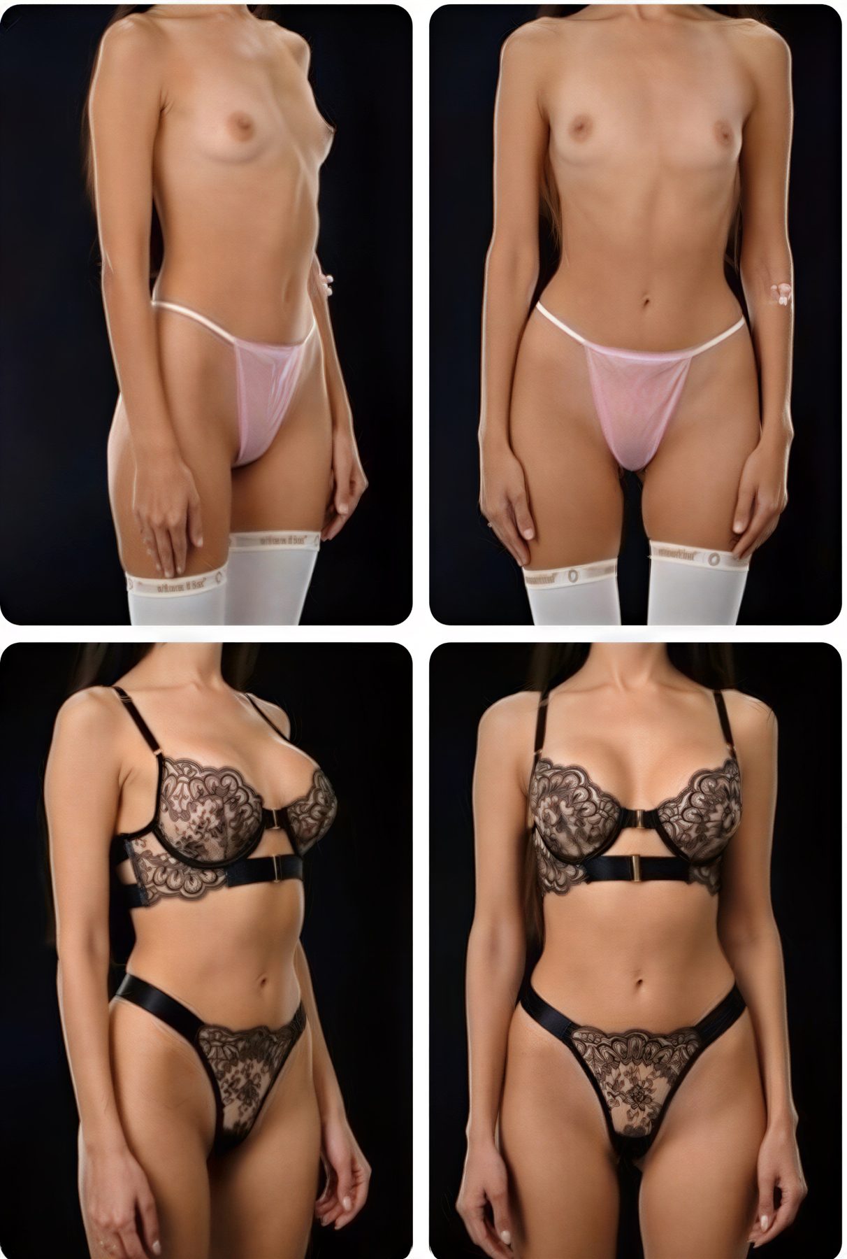 نتائج قبل وبعد تكبير الثدي في Yurchenko Plastic Surgery Team كييف