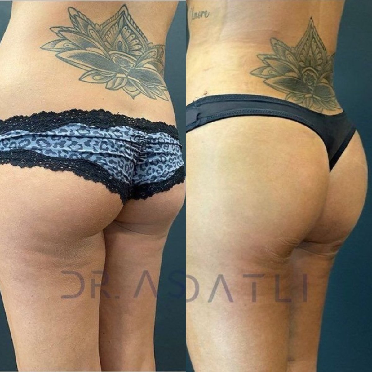 Результаты до и после Brazilian Butt Lift в Liv Hospital Ulus, улучшенный контур ягодиц