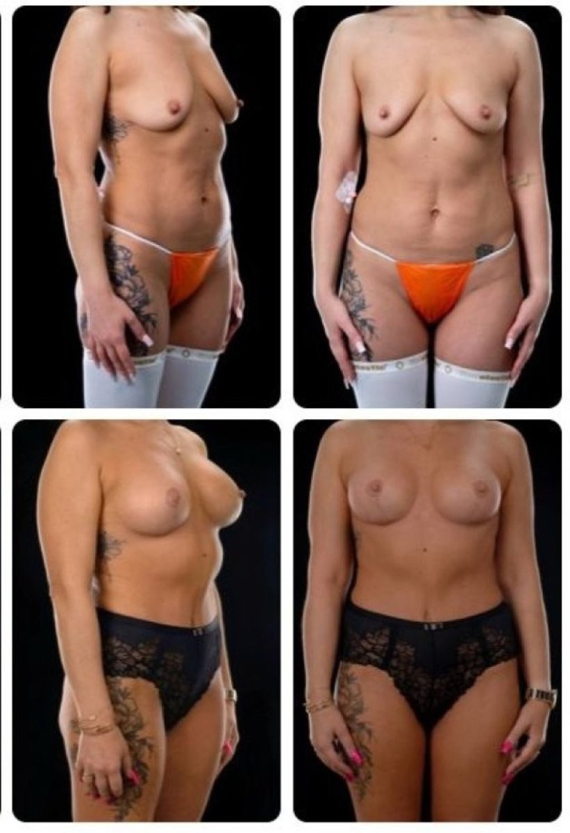 نتائج شد الثدي قبل وبعد في Yurchenko Plastic Surgery Team Kyiv، تحسين الشكل