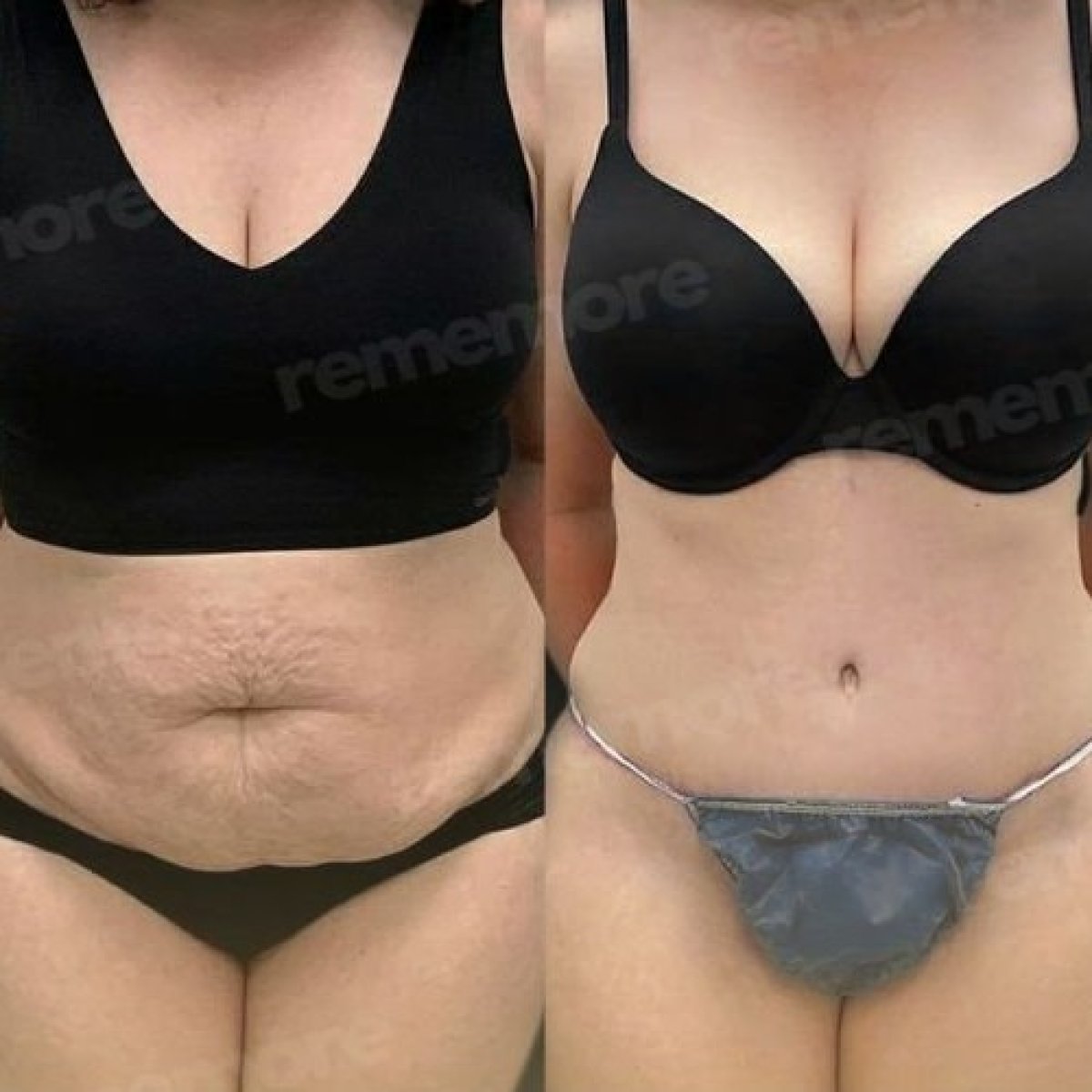 Before and after tummy tuck results at Memorial Antalya Hospital, improved abdominal contour