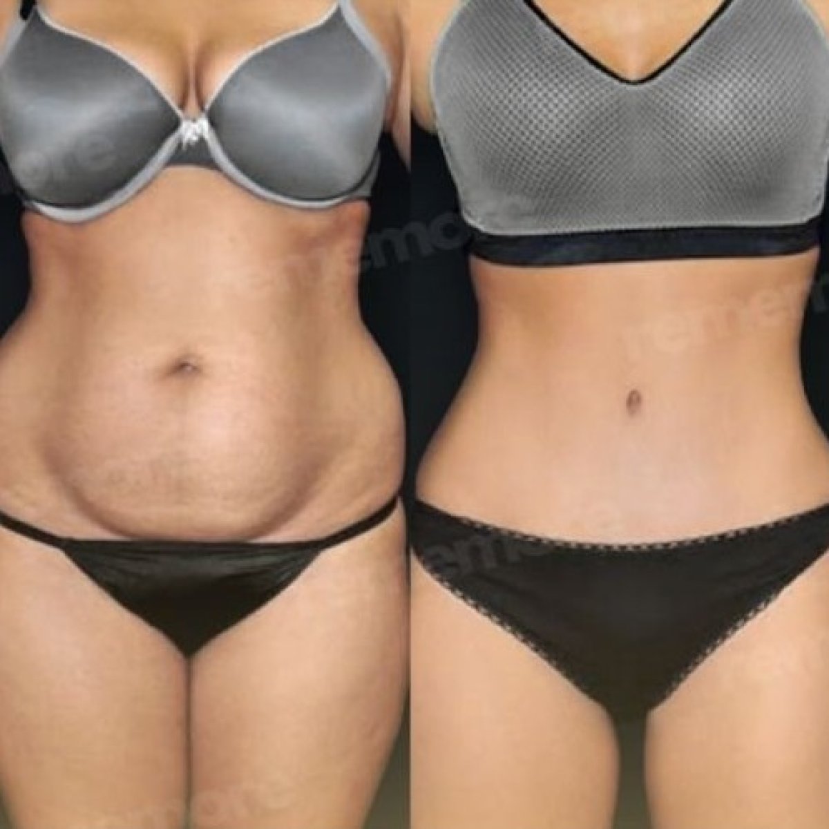 Before and after tummy tuck results at Memorial Antalya Hospital, visible abdominal contouring