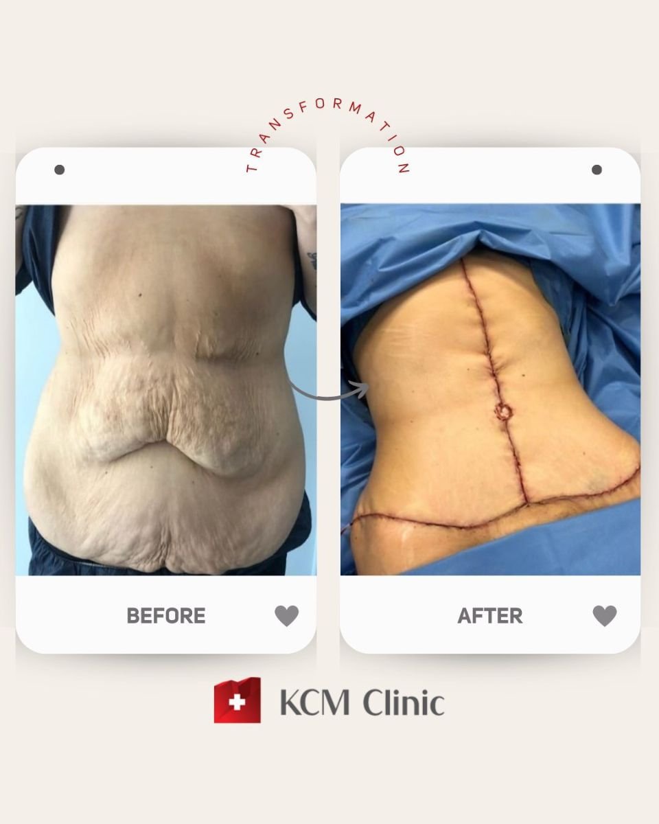Before and after tummy tuck and liposuction results at KCM Clinic, improved abdomen contour