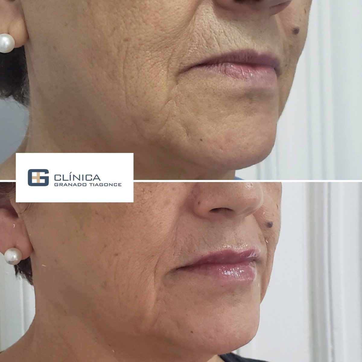 قبل وبعد حقن الفيلر في Clinica Granado Tiagonce، نتائج تجديد شباب الوجه