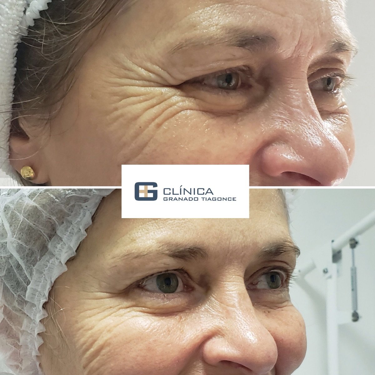 Результат до та після ін'єкцій філерів у Clinica Granado Tiagonce, зменшення зморшок