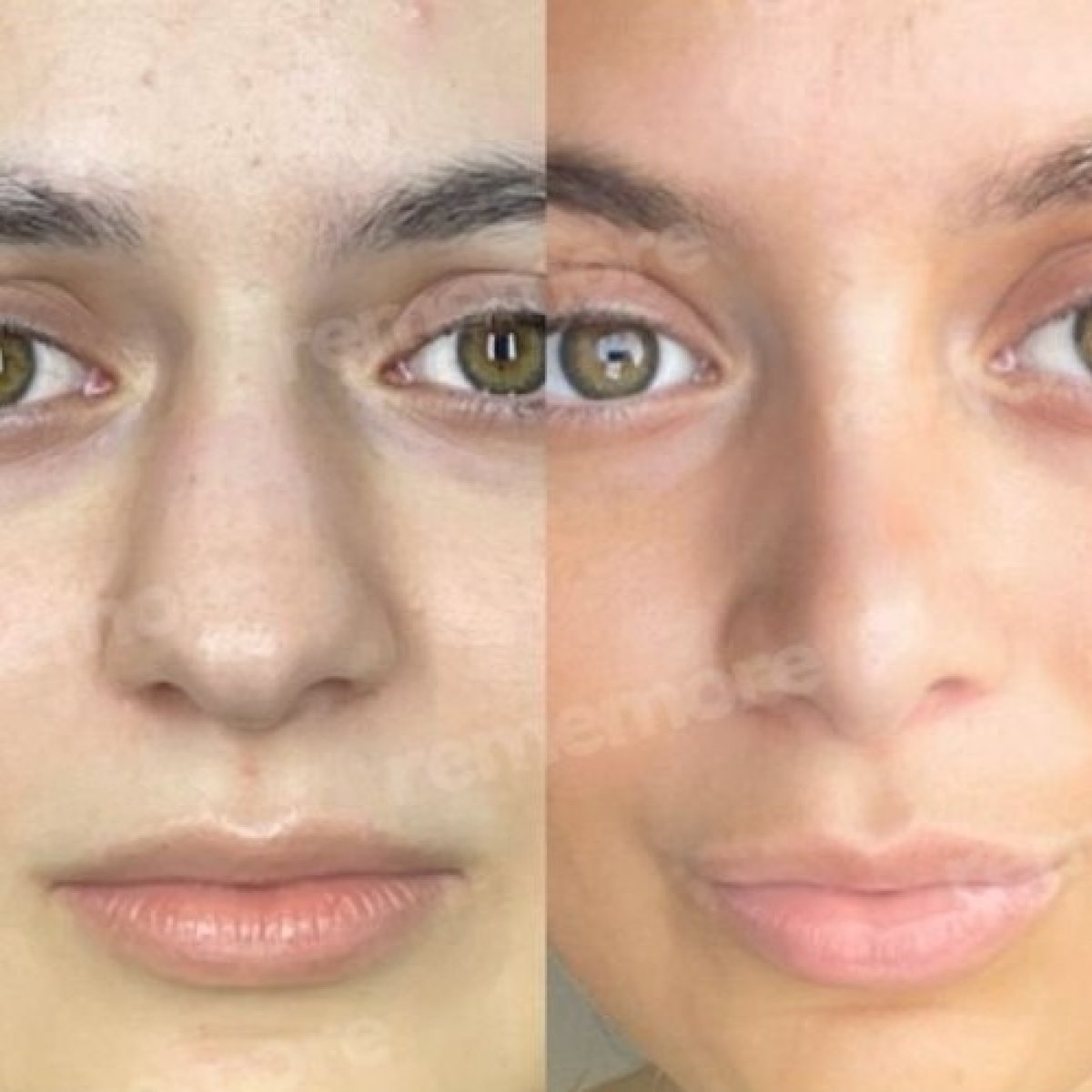 Before and after facial feminization surgery results at Memorial Şişli Hospital, refined features