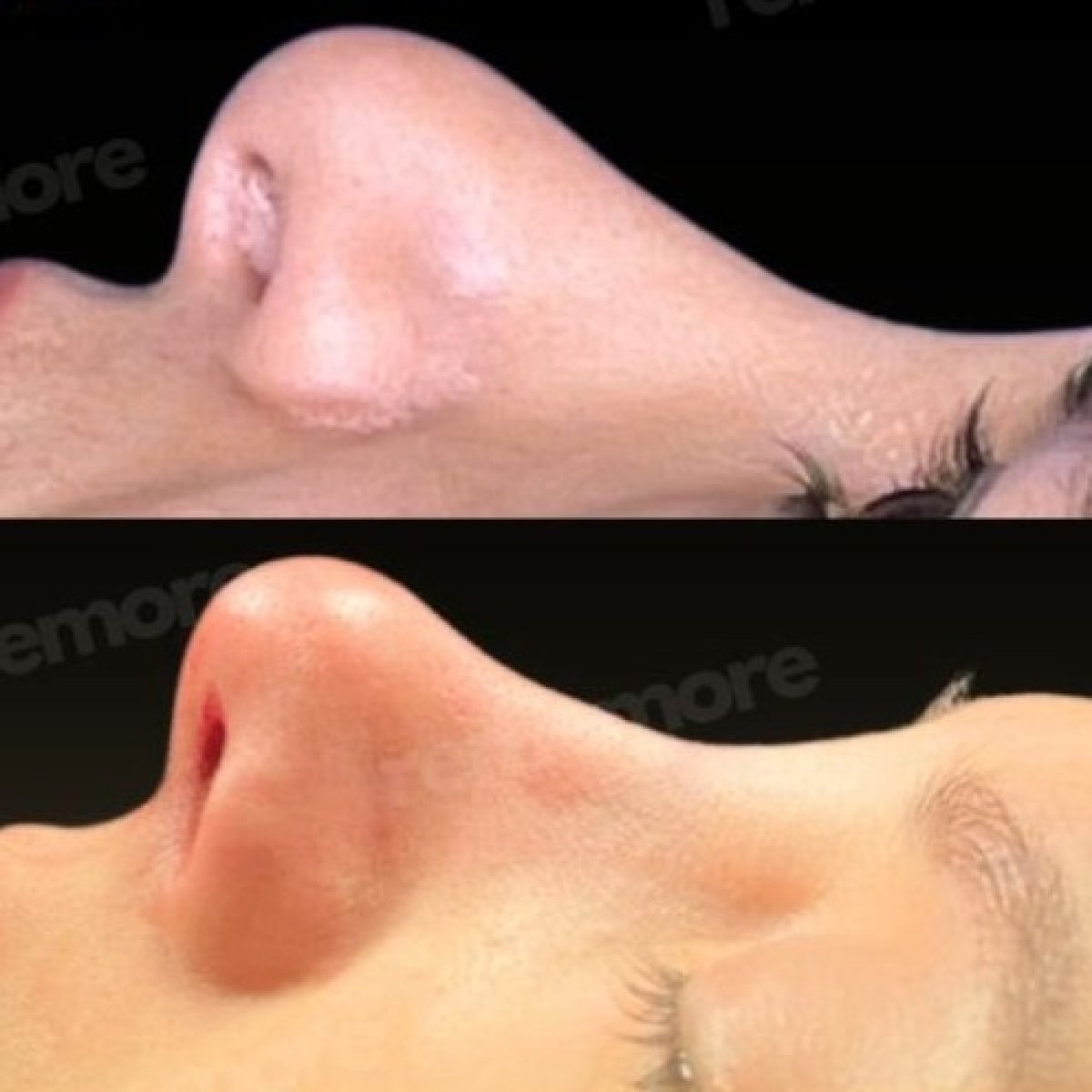 Before and after facial feminization surgery nose reshaping result at Memorial Şişli Hospital