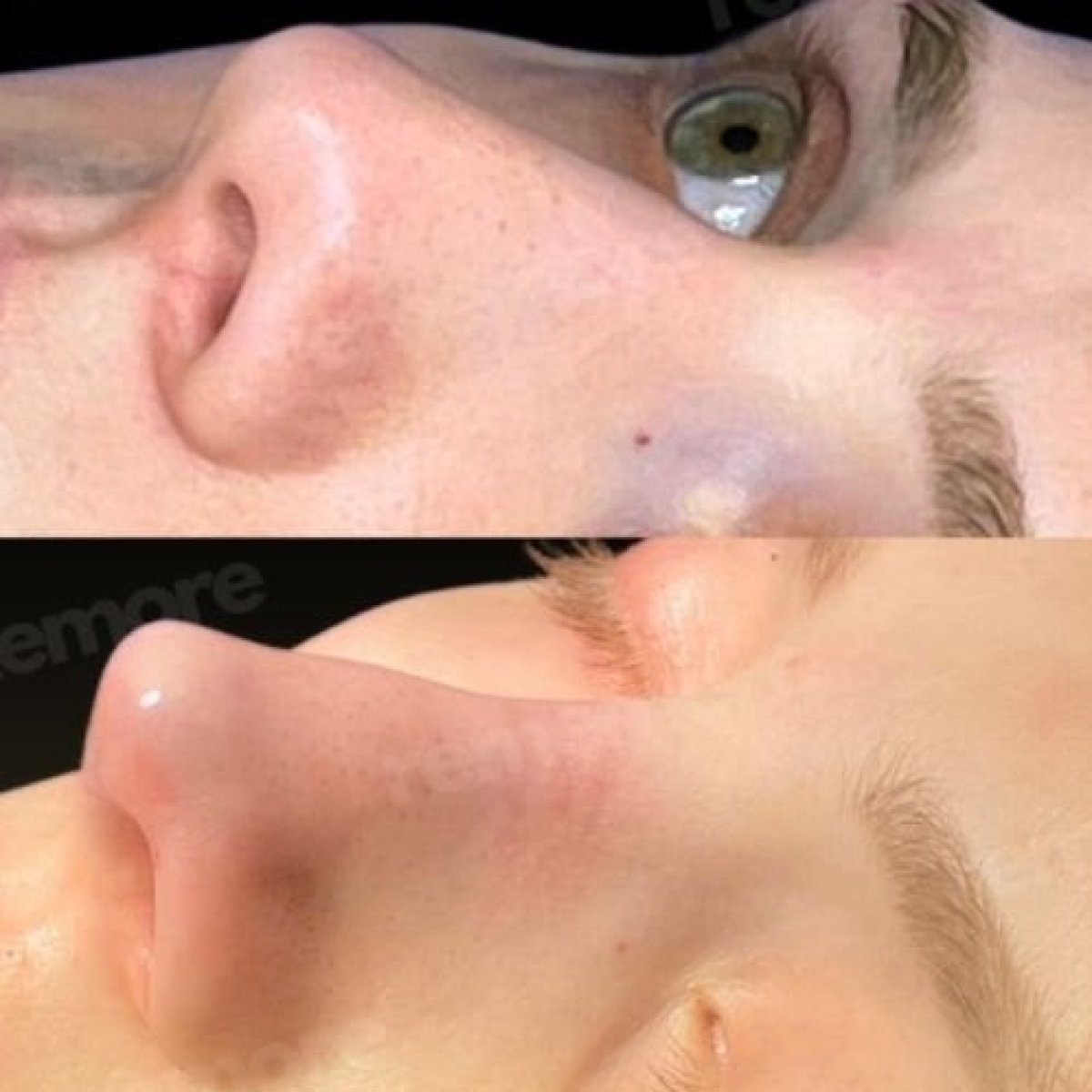 Before and after facial feminization surgery nose reshaping result at Memorial Şişli Hospital