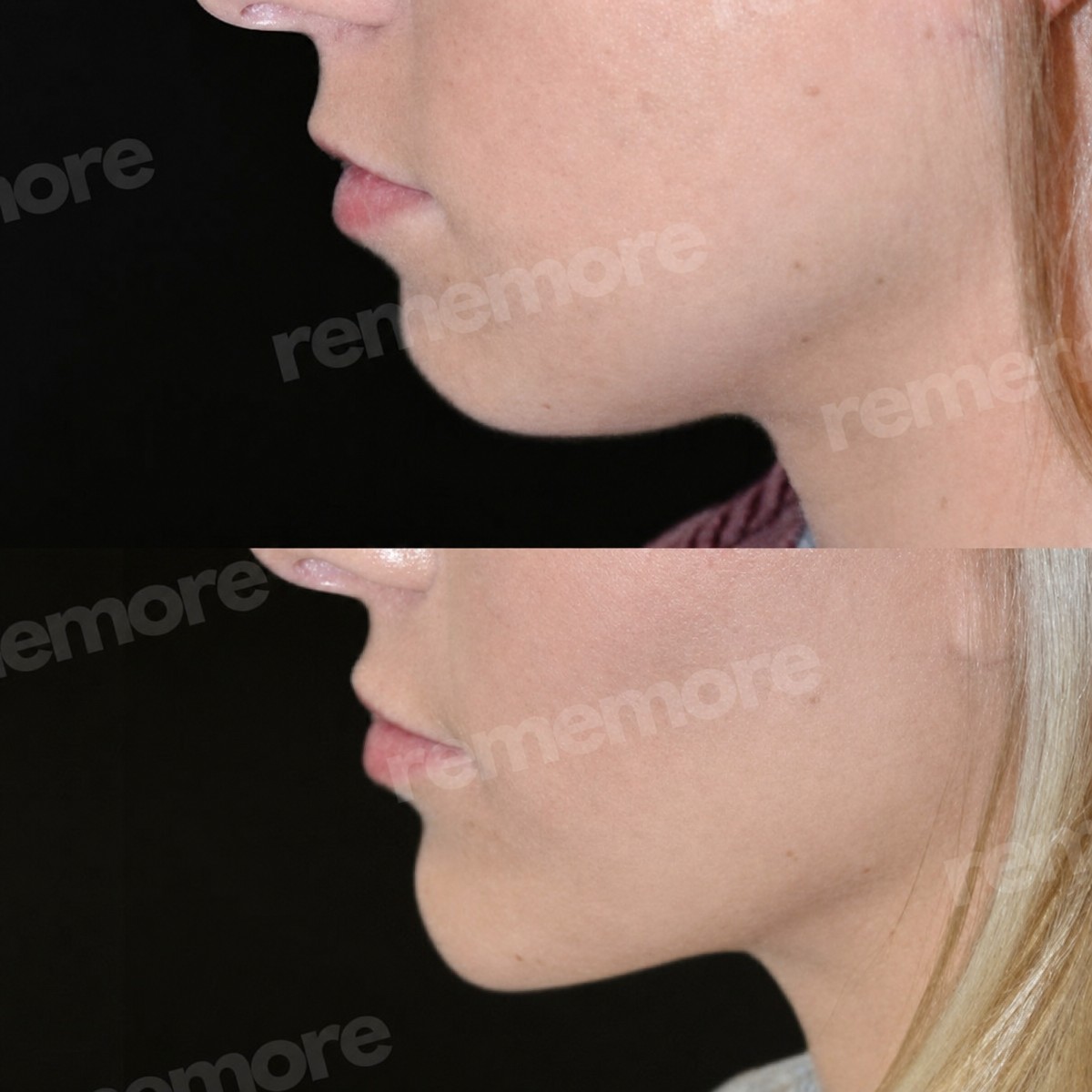 Before and after facial feminization surgery result at Memorial Şişli Hospital, jaw contouring