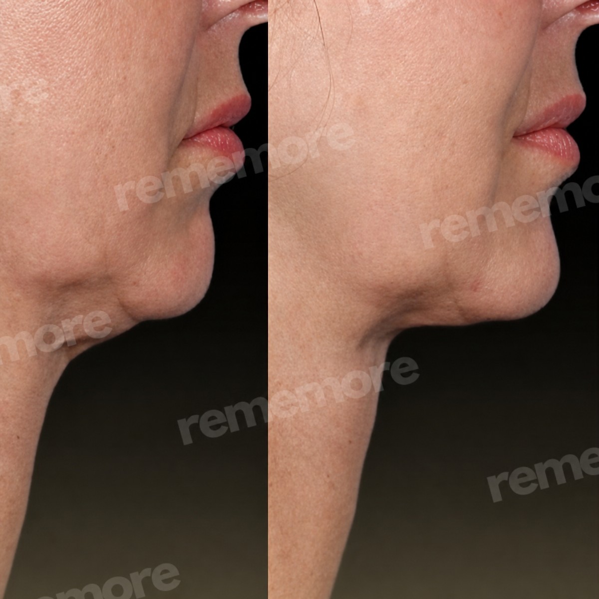 Facial feminization surgery before and after results at Memorial Şişli Hospital, jawline contour