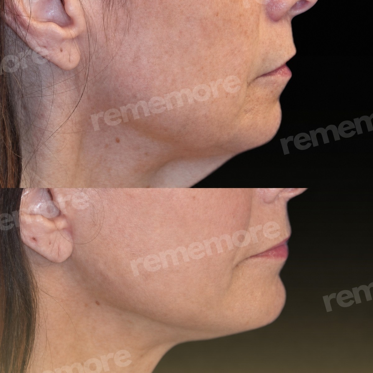 Facial feminization surgery before and after results at Memorial Şişli Hospital, jawline contour