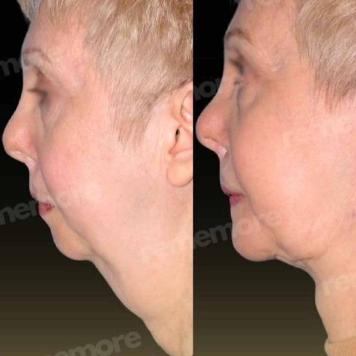 Facial feminization surgery before and after results at Memorial Şişli Hospital, profile view
