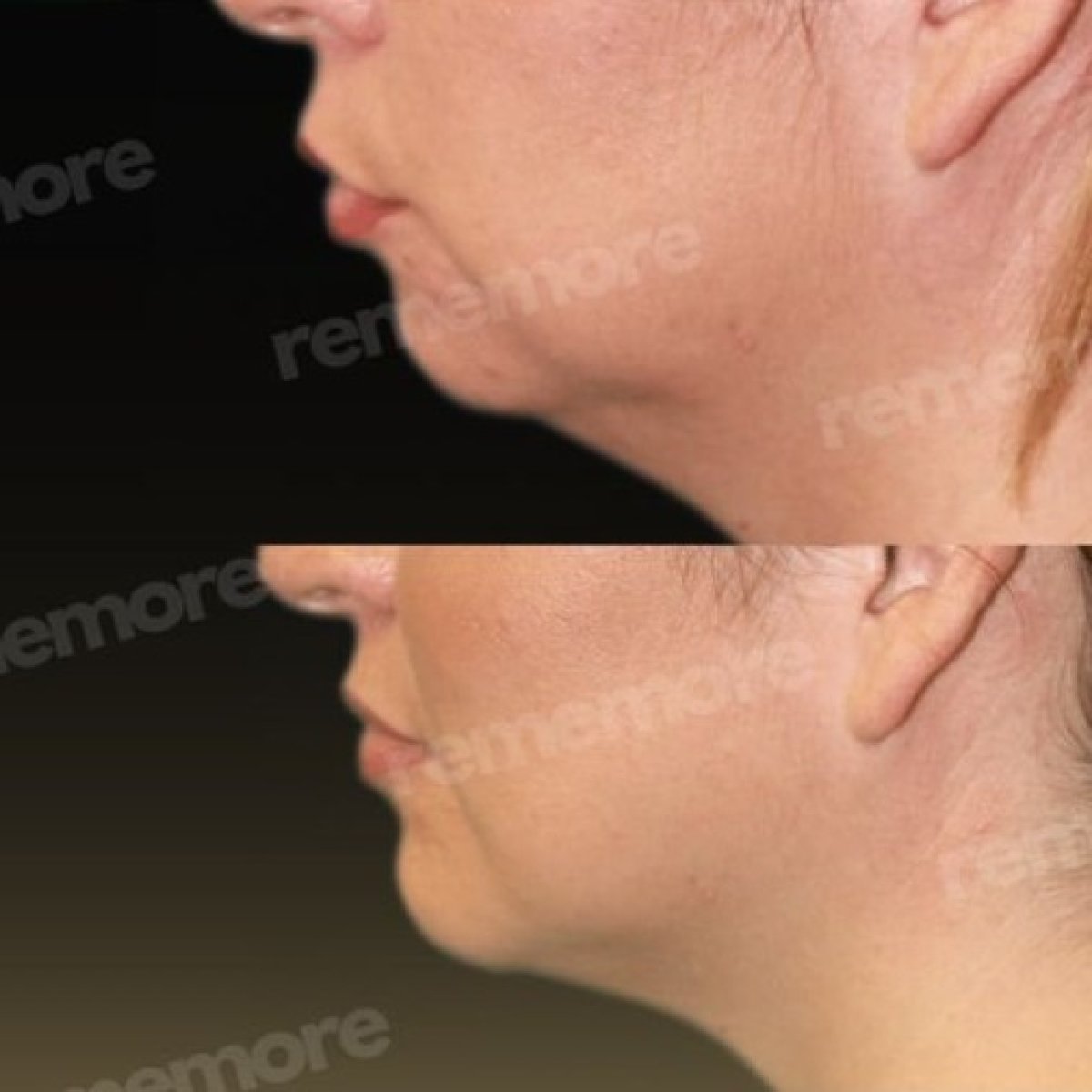 Before and after facial feminization surgery results at Memorial Şişli Hospital, jawline contour
