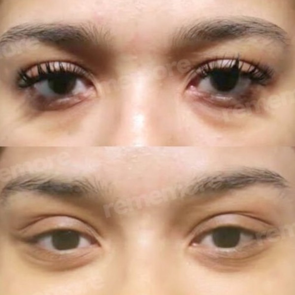 Facial feminization surgery before and after results at Memorial Şişli Hospital, eye area change