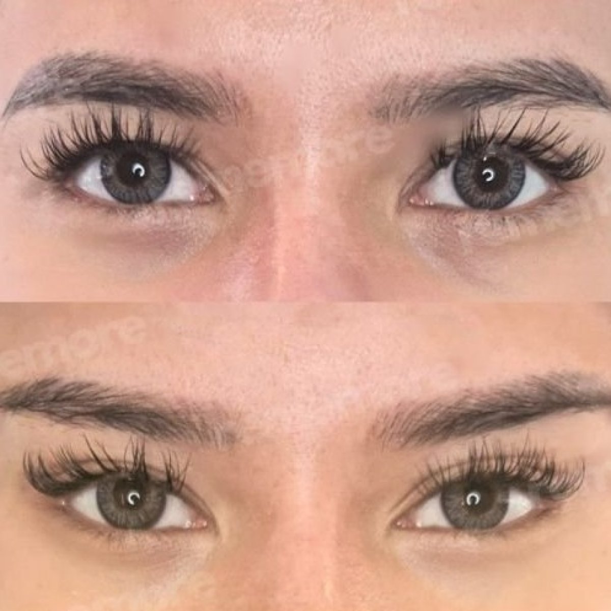 Facial feminization surgery before and after results at Memorial Şişli Hospital, eye area change