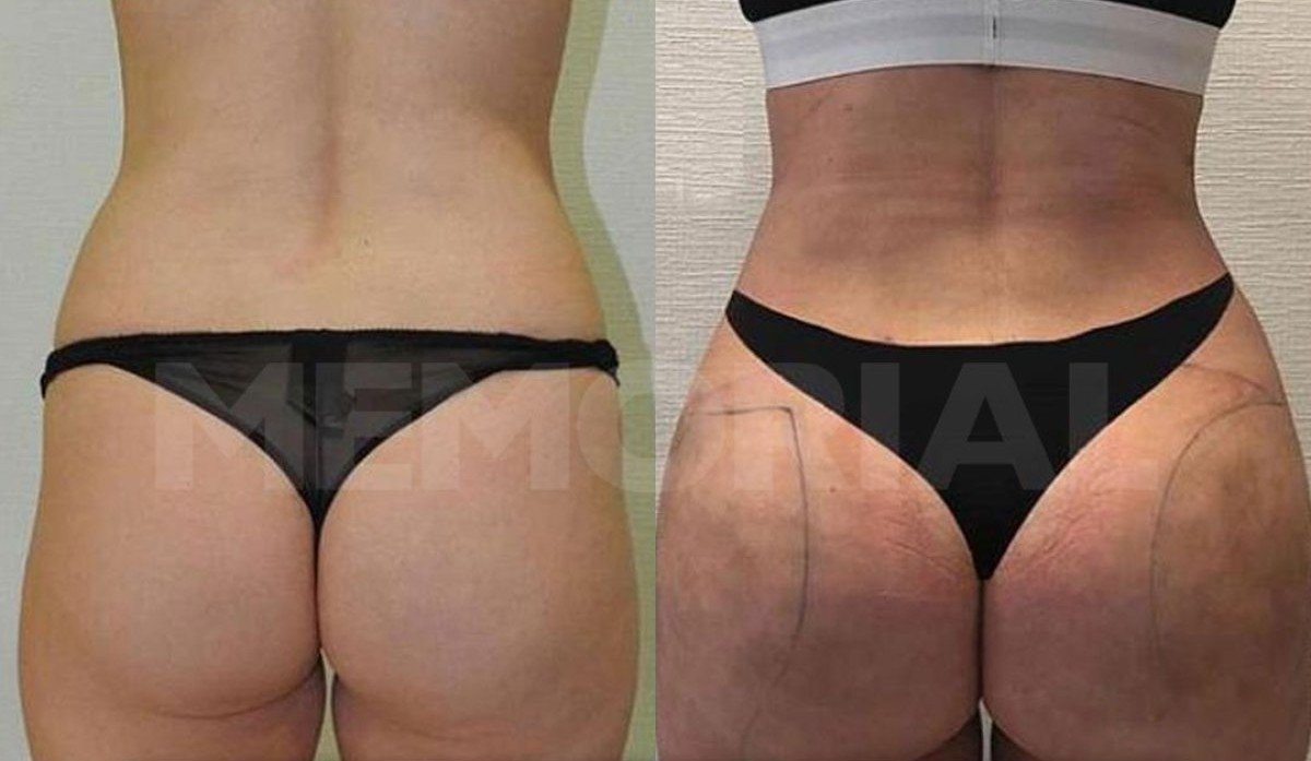 Before and after back liposuction results at Memorial Şişli Hospital, improved body contour